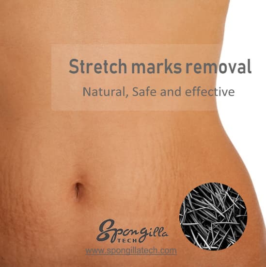 SpongillaTech stretch marks treatment  stretch marks